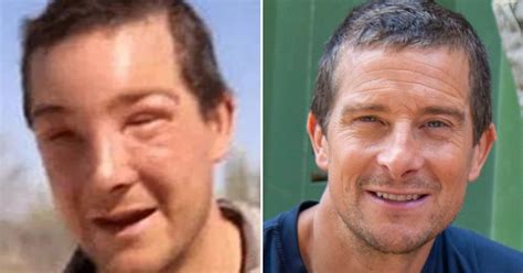 bear grylls bee sting